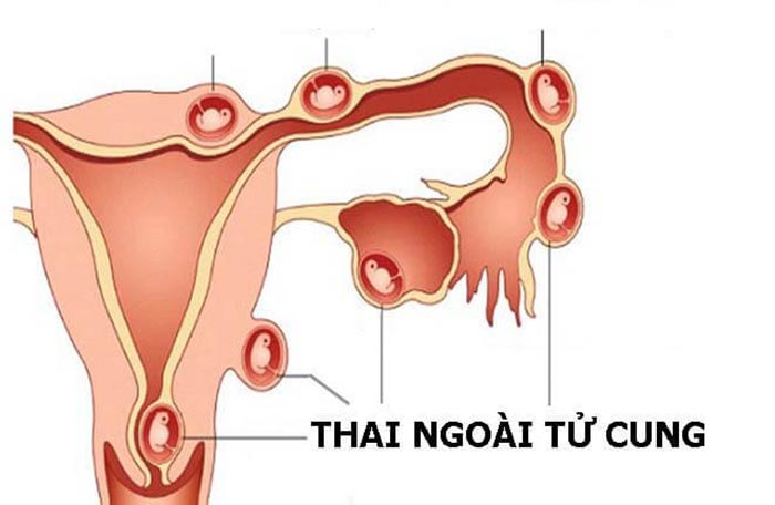 Mang thai ngoài tử cung khiến cơ thể tiết khí hư màu nâu