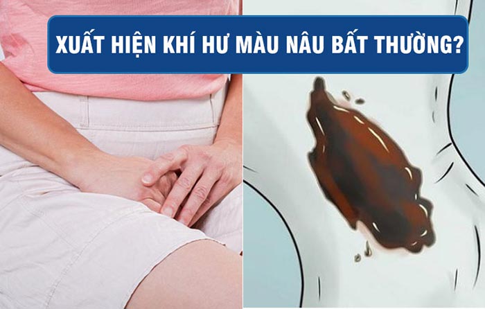 Mẹ bầu xuất hiện khí hư màu nâu như bã cà phê là dấu hiệu của sảy thai