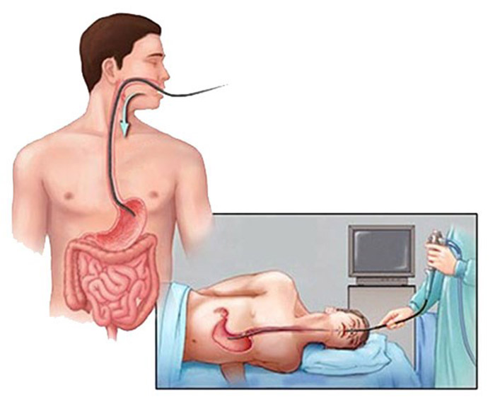 Nội soi dạ dày và nội soi đại tràng có thể được thực hiện cùng lúc với nhau