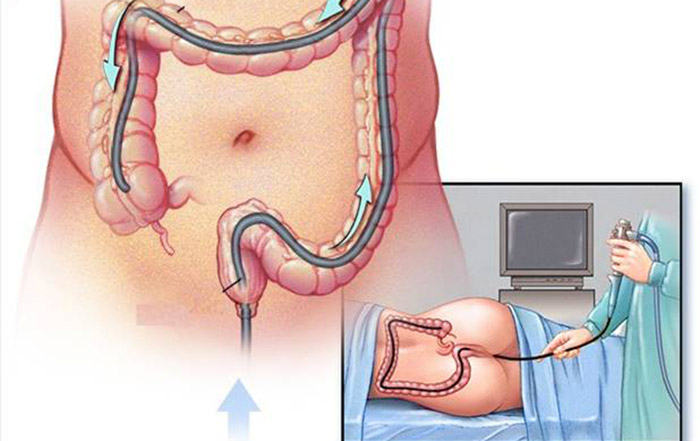 Cách các bác sĩ thực hiện nội soi đại tràng