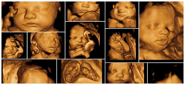 Được nhìn thấy những hình ảnh cảm xúc của em bé giúp giải đáp thắc mắc siêu âm 4D ở tuần 32 để làm gì rồi phải không?