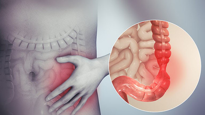 Bệnh nhân có các triệu chứng bất thường đường tiêu hóa dưới nên đi nội soi đại tràng