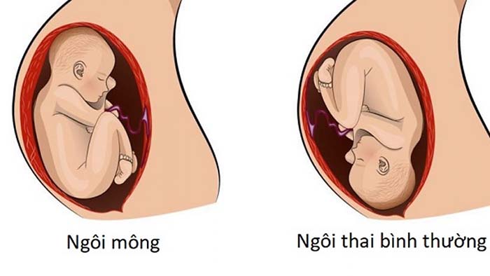 Siêu âm 4D ở tuần thứ 32, thường ngôi thai đã thuận với đầu bé quay xuống dưới sẽ dễ dàng sinh nở hơn