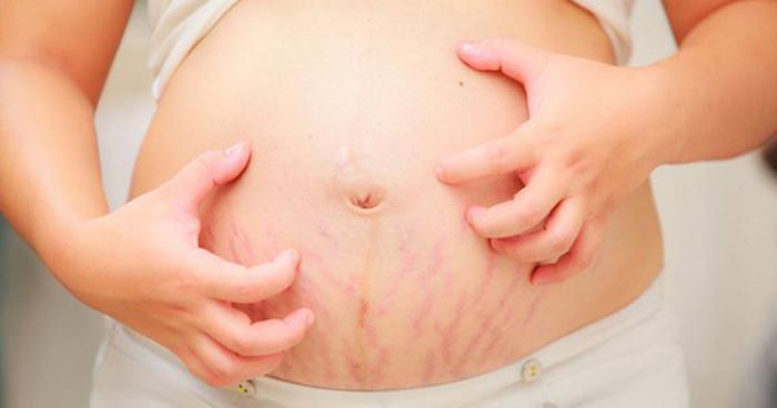 Tuần thứ 32 của thai kỳ mẹ sẽ thấy các biểu hiện ngứa vùng bụng do căng da