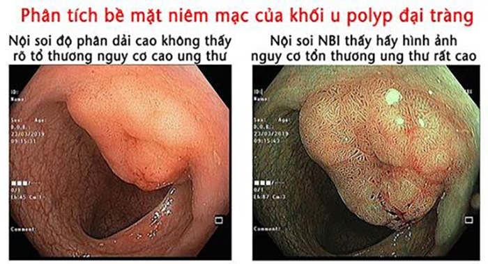 Nội soi đại tràng NBI không chỉ giúp phát hiện các thương tổn nhỏ nhất mà còn có thể phát hiện sớm các dấu hiệu ung thư đại tràng