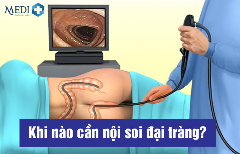 Quy trình nội soi đại tràng như thế nào? Cần lưu ý những gì