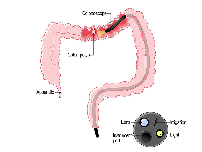 Hình ảnh nội soi đại tràng phát hiện Polyp đại tràng