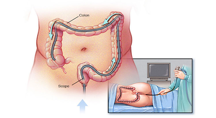 Nội soi đại tràng có phát hiện trĩ không?