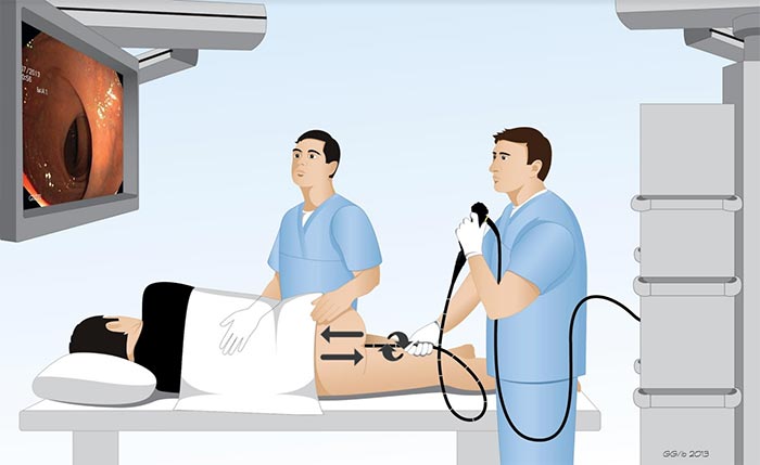 Quy trình bác sĩ thực hiện nội soi đại tràng phát hiện trĩ