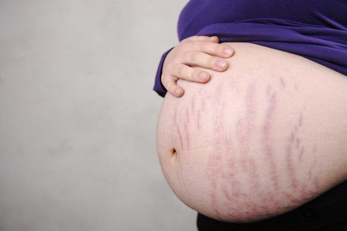 Những tháng cuối của thai kỳ kích thước bụng bầu lớn mẹ có thể bị rạn da ở bụng
