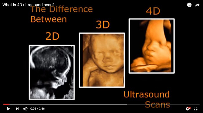 Rất nhiều mẹ muốn biết siêu âm 3D và 4D khác nhau như thế nào vì hai kỹ thuật này có khá nhiều điểm tương đồng