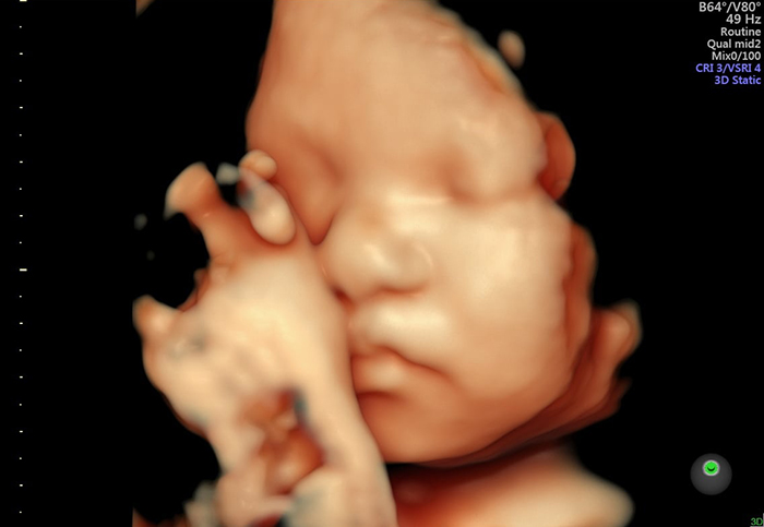 Siêu âm 3D sử dụng 3 chiều không gian giúp thu được hình ảnh tĩnh của thai nhi ở nhiều góc độ khác nhau