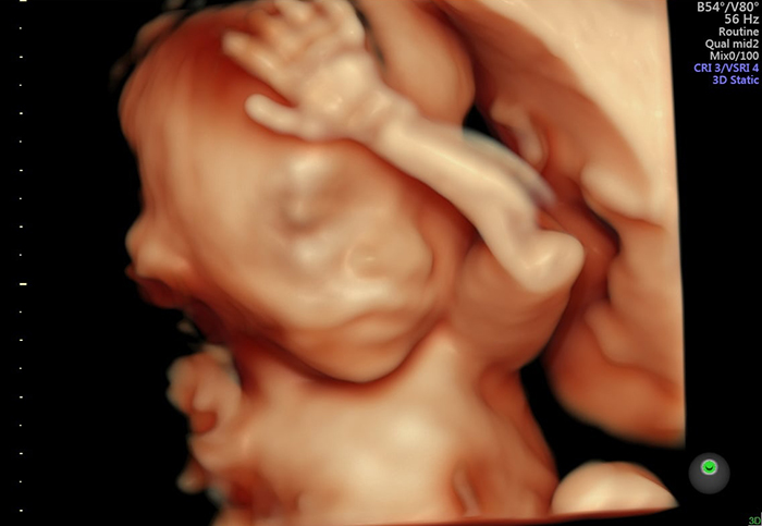 Siêu âm 3D vào tuần thai 22 để kiểm tra và đánh giá hình thái học của thai nhi đồng thời phát hiện các thường ở nội tạng tim, não, thận nếu có