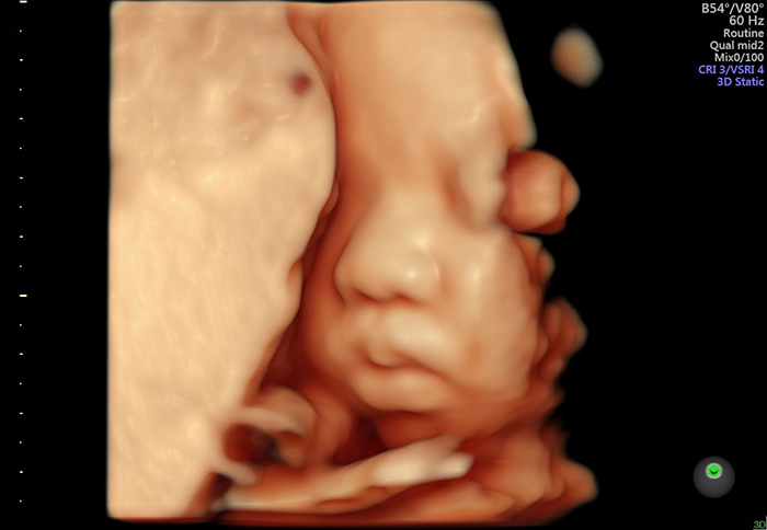 Siêu âm 3D vào tuần 32 nhằm đánh giá tình trạng sức khoẻ tổng thể của thai nhi trước ngày sinh và phát hiện các bất thường muộn
