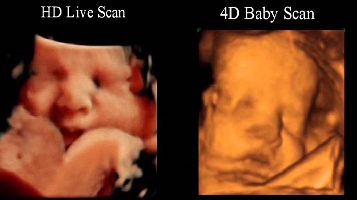 Siêu âm 4D đưa ra cả một thước phim với các cử động của thai nhi với hình ảnh 3D và video 4D