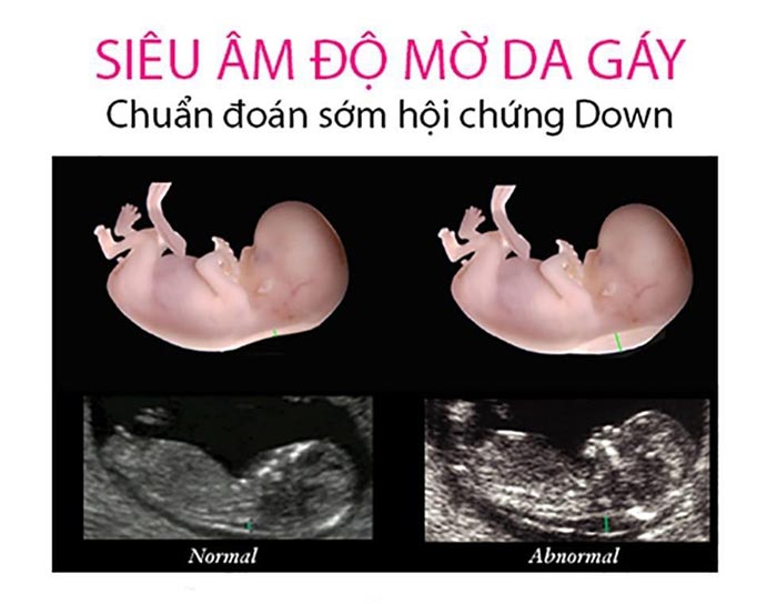 Khoảng sáng sau gáy càng dày thì nguy cơ thai nhi mắc bệnh down càng cao