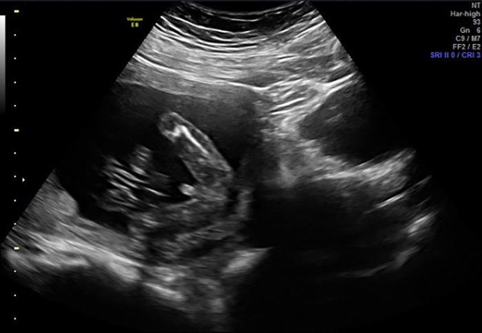 Siêu âm 2D giúp phát hiện các bất thường hình thái của thai nhi ở tuần thứ 16