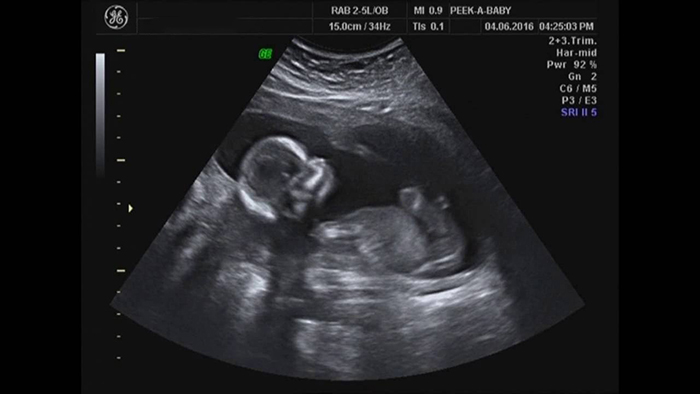 Siêu âm 2D ở tuần 16 đã phát hiện được giới tính thai nhi