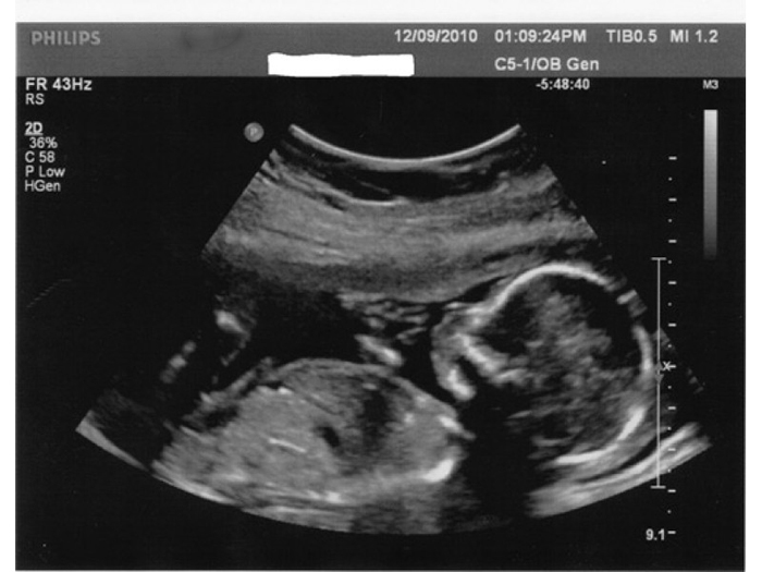 Hình ảnh 2D ở tuần 16 cho thấy rõ đầu, chân, tay của bé