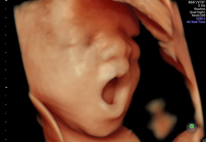 Tuần thứ 32 khi siêu âm mẹ có thể nhìn thấy hành động ngáp ngủ của bé