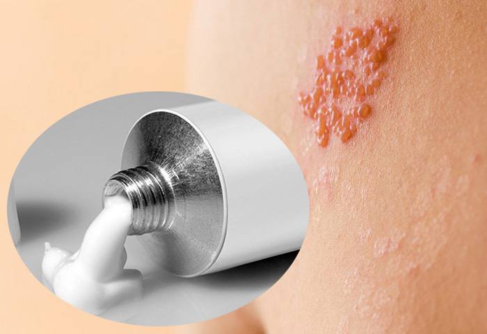 Các thuốc kháng virus, kháng sinh, kháng viêm… thường được dùng để điều trị zona ở mẹ bầu