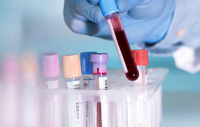 Xét nghiệm máu  kiểm tra tình trạng sức khỏe là cần thiết trước khi nội soi