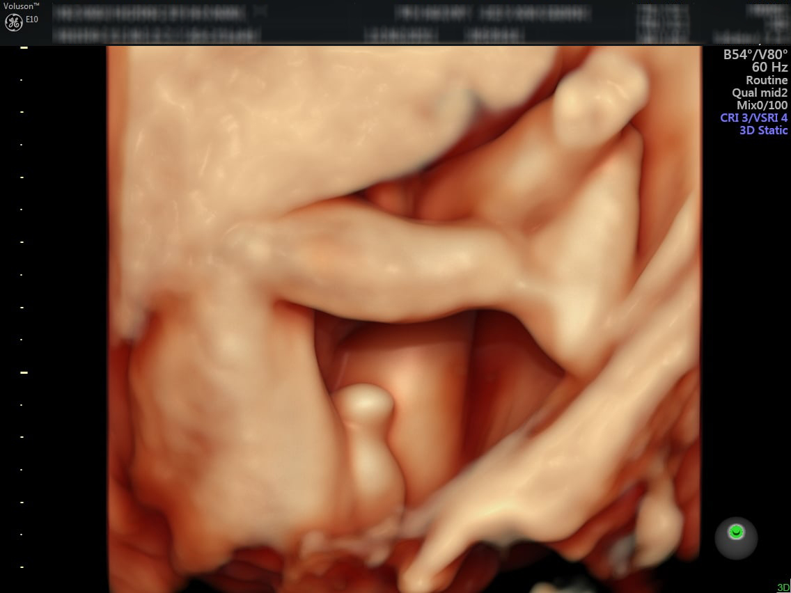 21 tuần là giai đoạn thai nhi đã phát triển khá đầy đủ về bộ phận sinh dục giúp nên việc siêu âm 4D để xác định giới tính chính xác hơn