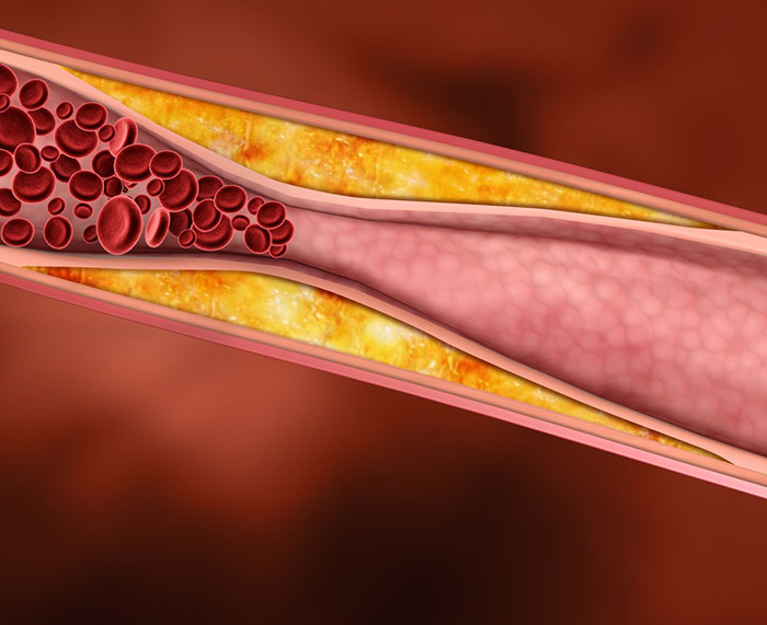 Chất béo trong mì tôm làm tăng hàm lượng cholesterol khiến máu khó lưu thông