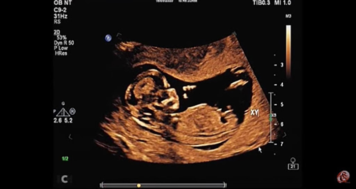 Bộ phận sinh dục của thai nhi 12 tuần xuất hiện 1 chồi nhỏ, sau đó được chia ra thành rãnh nhỏ và dần hình thành cơ quan