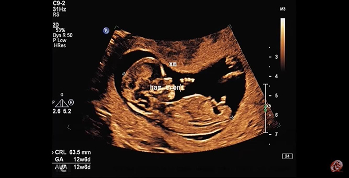 Đầu của thai nhi 13 tuần có thể bằng ½ kích thước thân mình
