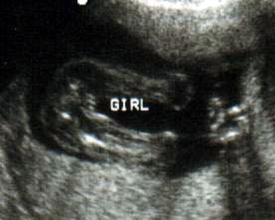 Hình ảnh bé gái 16 tuần trên siêu âm 2D