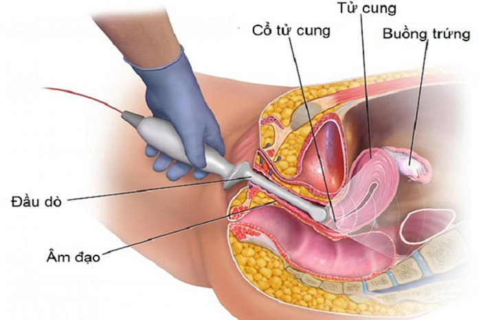Siêu âm đầu dò giúp xác định vị trí của thai ở trong hay ngoài tử cung
