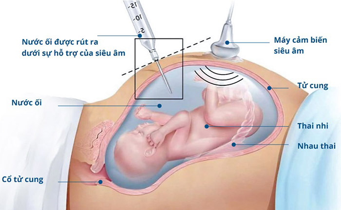 Quy trình chọc ối