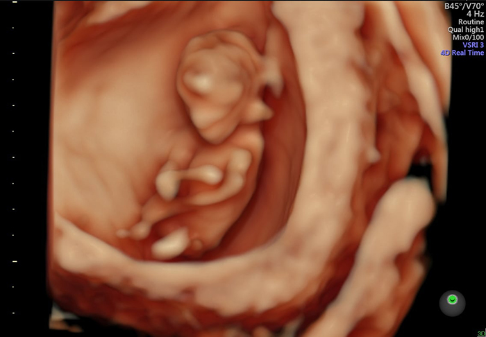 Siêu âm thai 4D ở tuần 12 giúp sàng lọc các dị tật thai nhi trước sinh