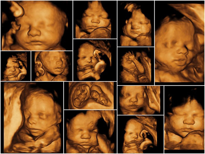 Siêu âm 3D cho thấy những hình ảnh 3 chiều về các chuyển động đang xảy ra bên trong cơ thể của mẹ và bé