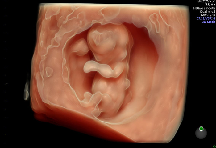 Kết quả siêu âm thai 4D ở 12 tuần có độ chính xác tới 99%