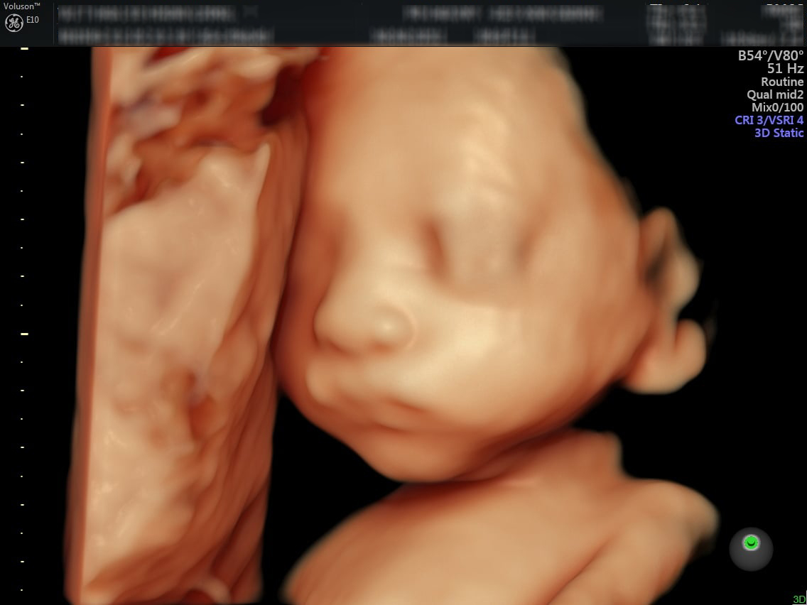 Siêu âm 4D cho hình ảnh thai nhi rõ nét, chân thực và sống động ở nhiều góc độ khác nhau