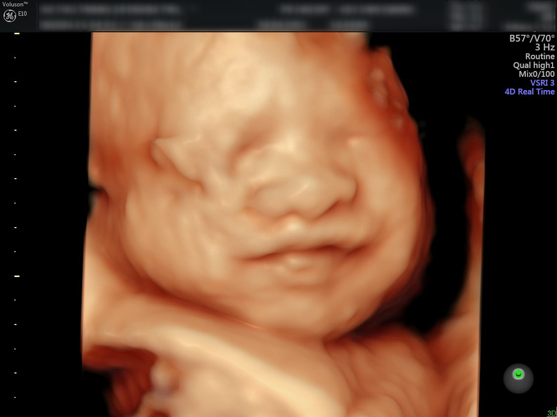  Siêu âm 4D giúp mẹ có thể nhìn thấy được các cử chỉ của em bé khi ở trong bụng như cười, mút ngón tay, nấc...