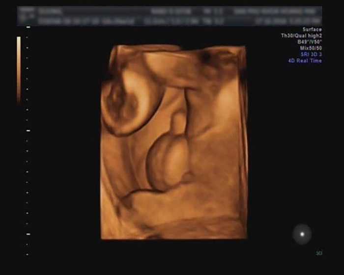 Bác sĩ sẽ chẩn đoán thai nhi là bé trai nếu trên hình ảnh siêu âm thấy dương vật và bìu tại vùng bộ phận sinh dục