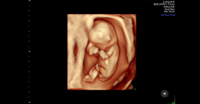 Siêu âm 4D 13 tuần có thể thấy thai nhi phát triển thế nào?