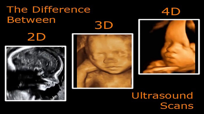 Siêu âm 3D, 4D làm tăng trải nghiệm cho ba mẹ