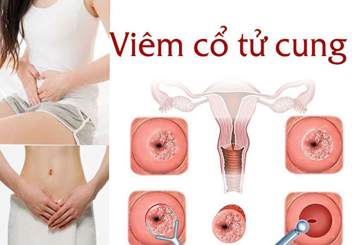 Cổ tử cung khi bị viêm do vi khuẩn và nấm gây ra