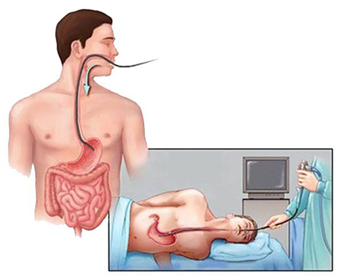 Bệnh nhân có thể bị chướng bụng nhẹ, đau bụng sau nội soi dạ dày.