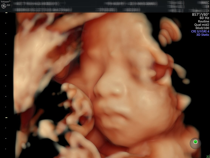 Siêu âm 4d thai ở tuần 27 ho phép đánh giá hình thái của thai nhi