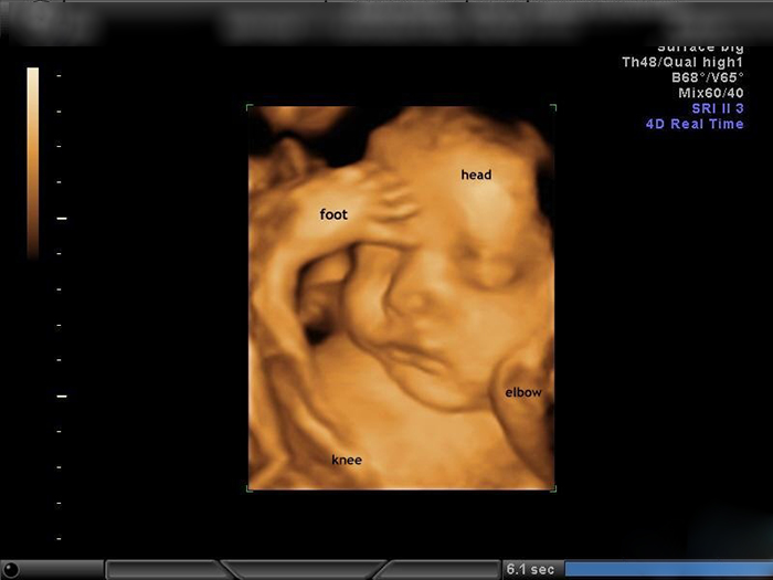 Hình ảnh siêu âm 4D em bé trong bụng mẹ khi được 31 tuần