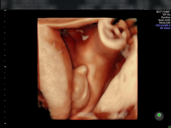 Hình ảnh siêu âm 4D thai bé trai