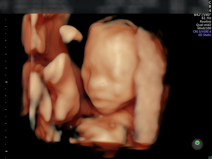 Hình ảnh siêu âm 4D cho thấy đầu và mặt em bé