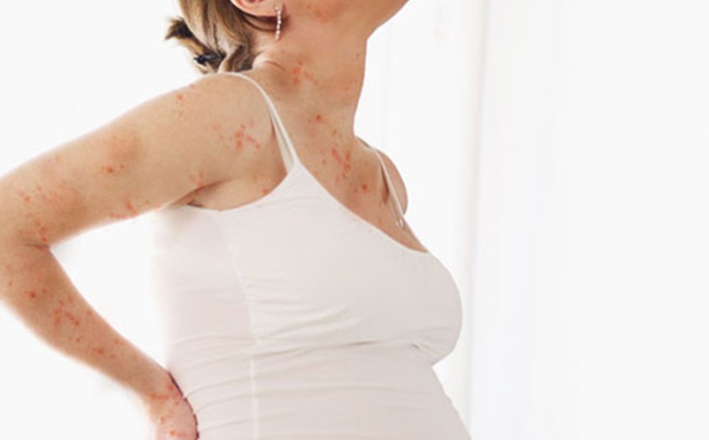 Mẹ bầu có nguy cơ cao bị dị ứng nếu ăn quá nhiều cà tím