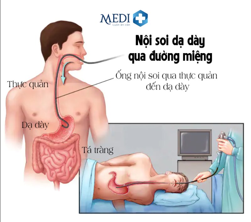 Nội soi dạ dày qua đường miệng 