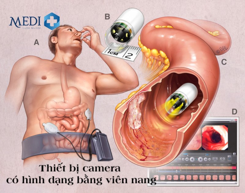 Nội soi dạ dày bằng viên nang 